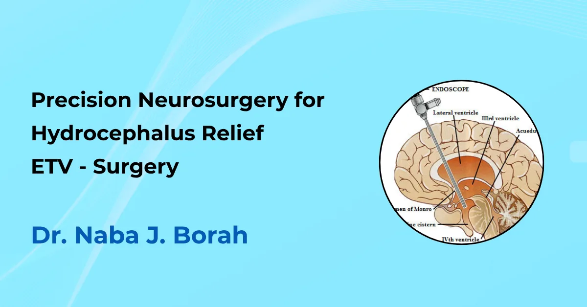 Precision Neurosurgery for Hydrocephalus Relief by Dr Naba J Borah